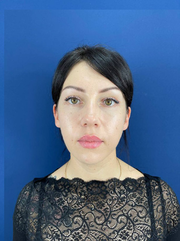 Липофилинг лица и блефаропластика в Симферополе – фото 48